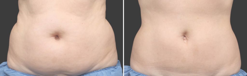 Before After CoolSculpting