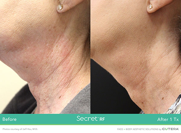 Discover the power of Secret RF Microneedling treatment in Stamford, CT for skin health.